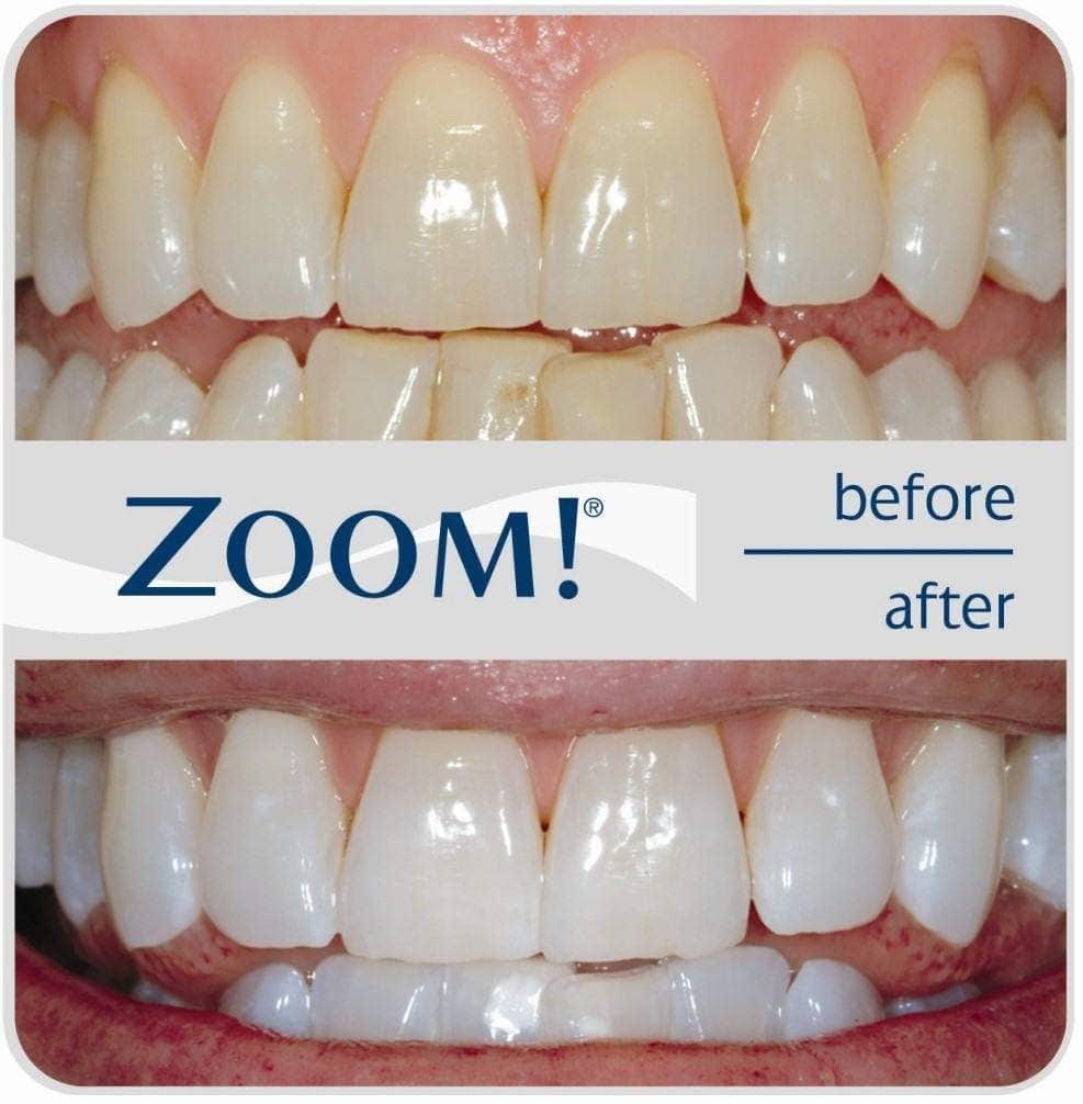 Zoom Teeth Whitening