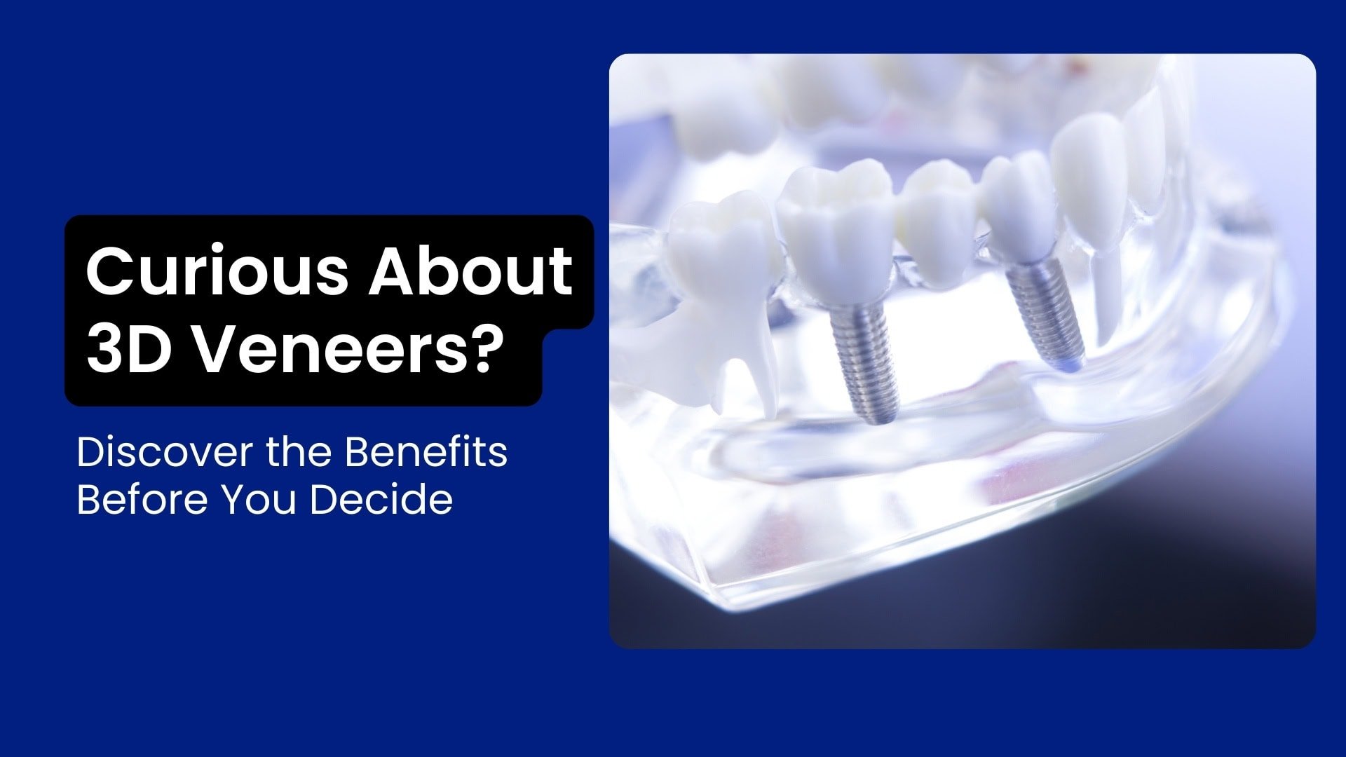 Curious About 3D Veneers? Discover the Benefits Before You Decide