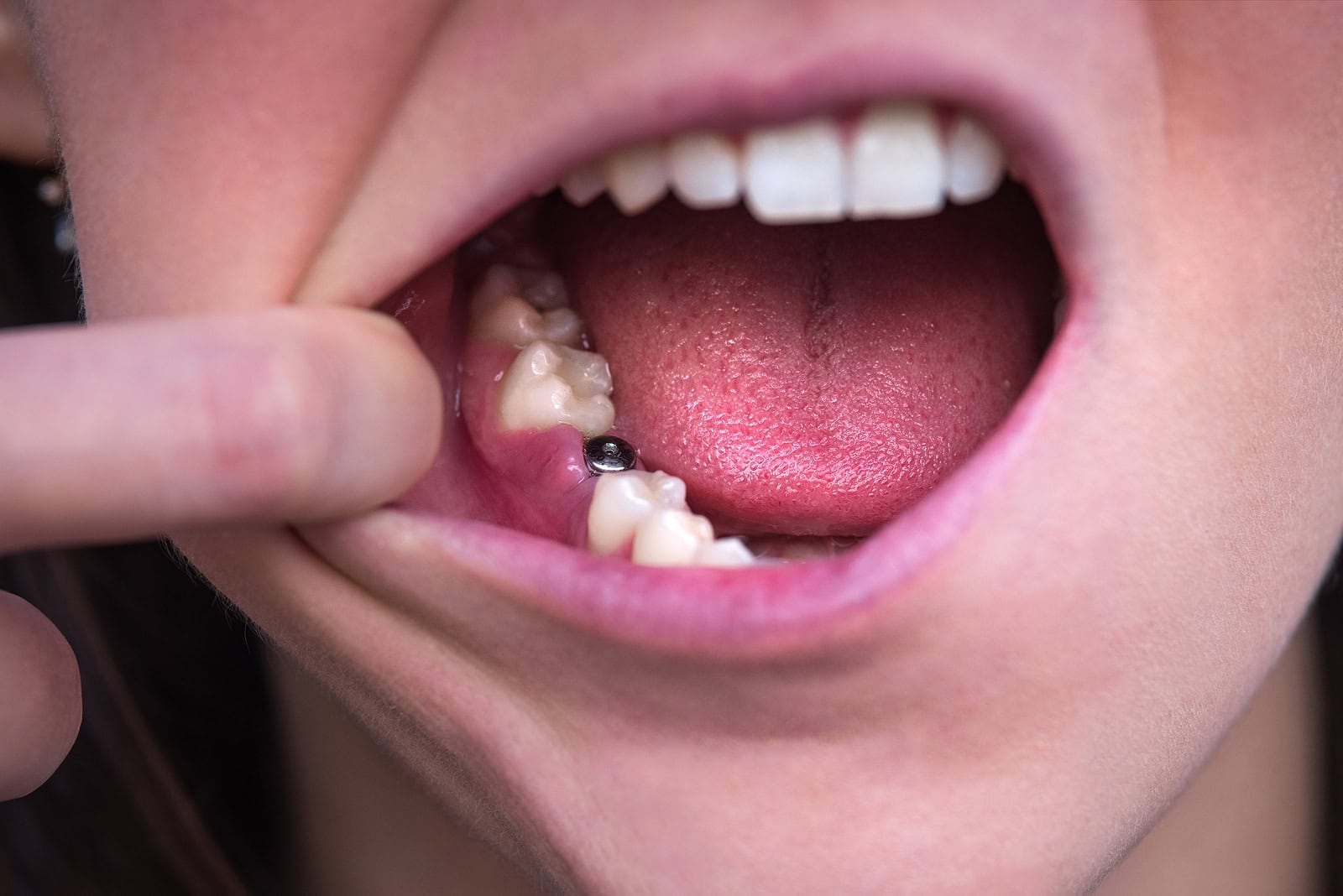 Tooth Replacement After Extraction