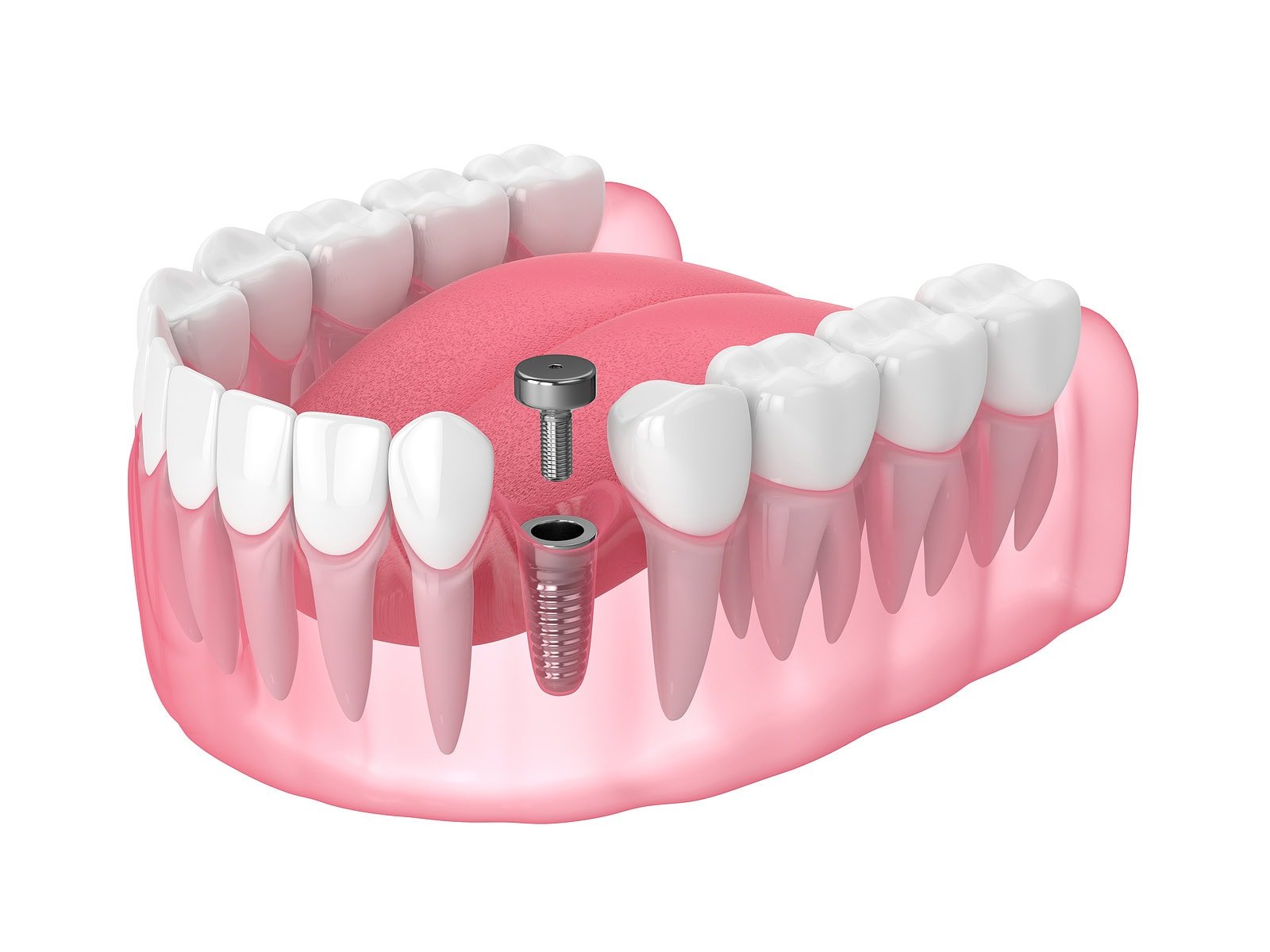 How Nutrition Impacts Osseointegration in Dental Implants