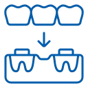 Replacing Several Teeth